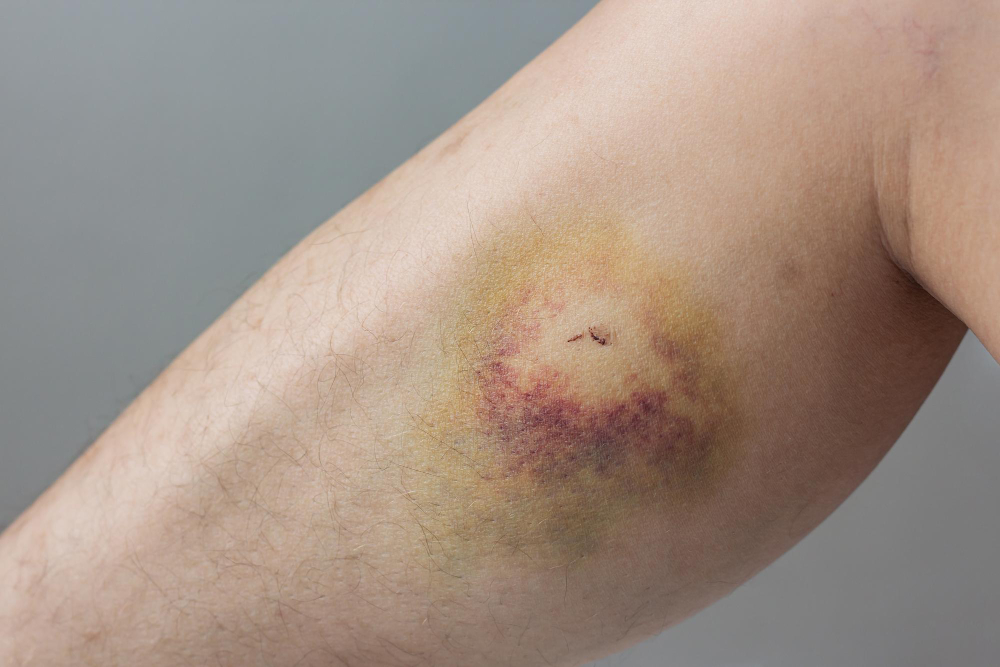 bruise