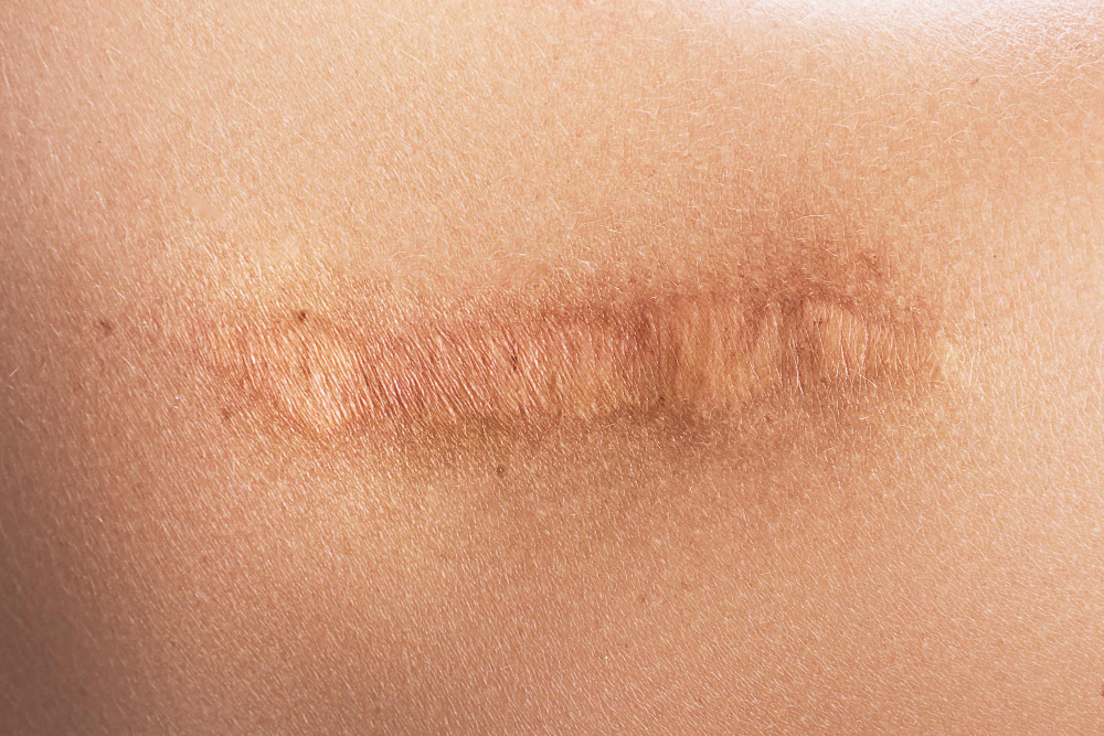 Scar