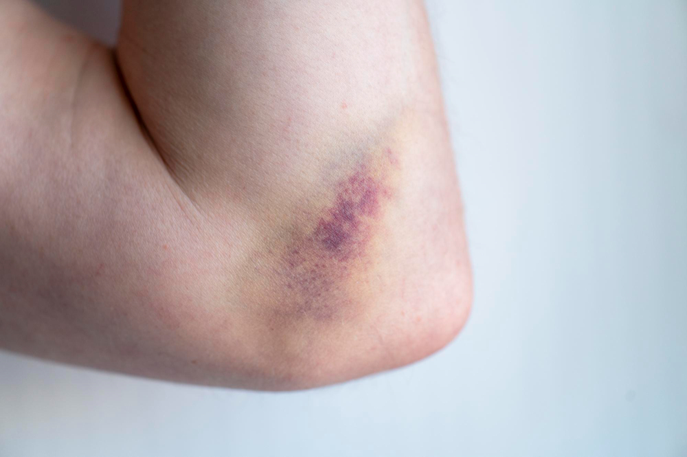 bruise