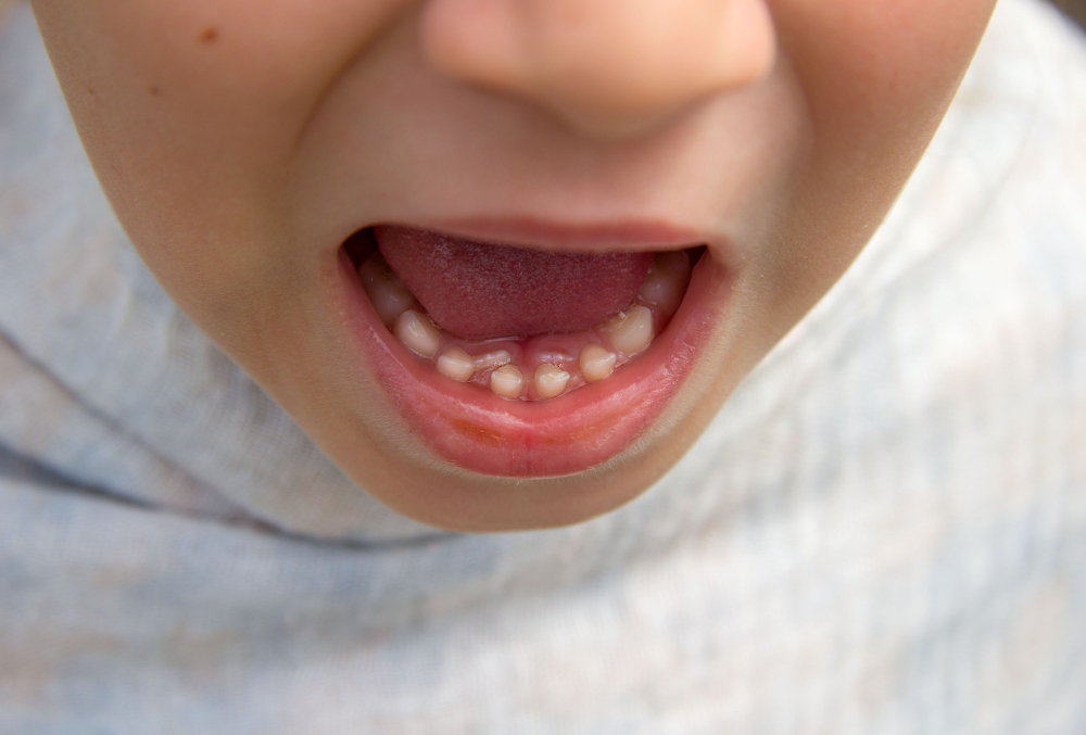 Milk Teeth