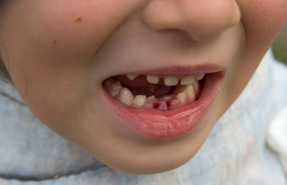 Milk Teeth