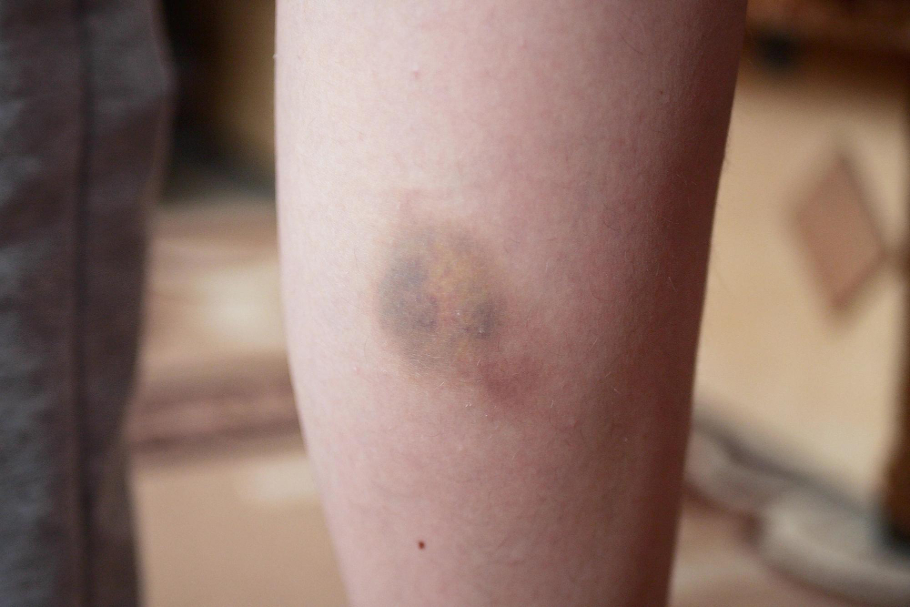 bruise