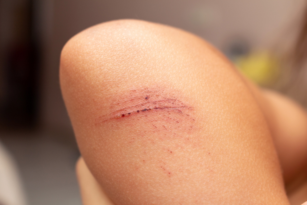 wound healing