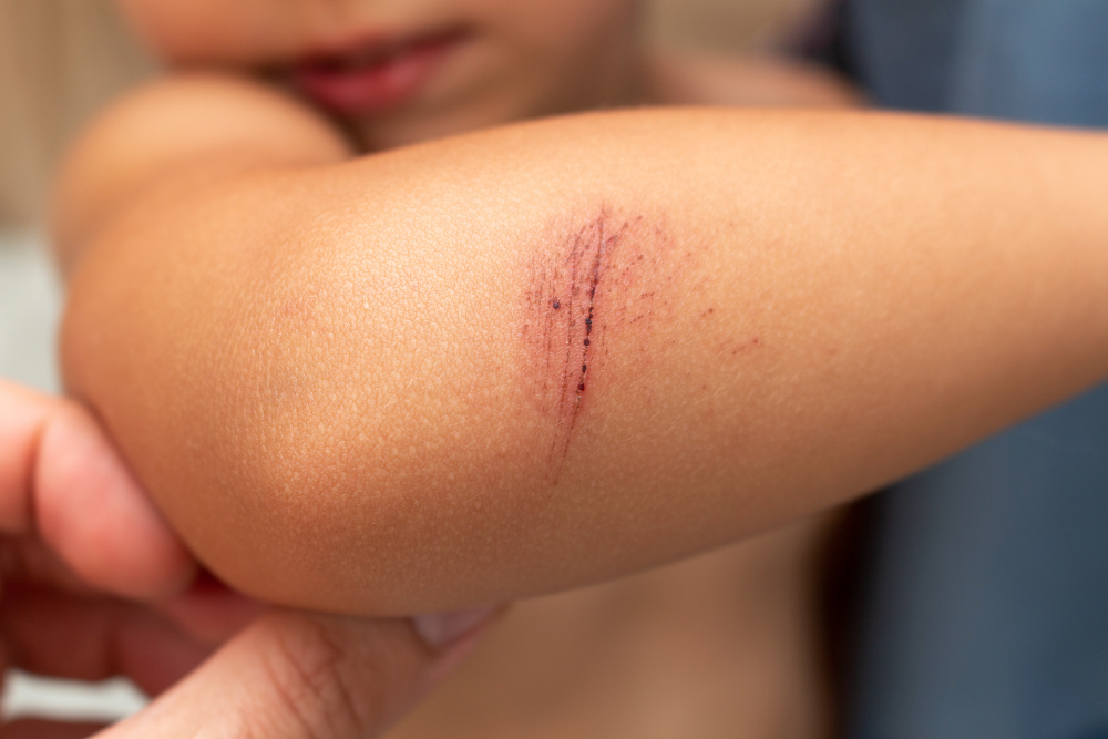 wound healing