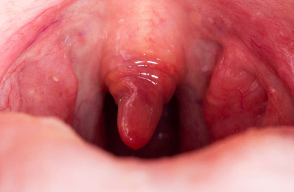 uvula