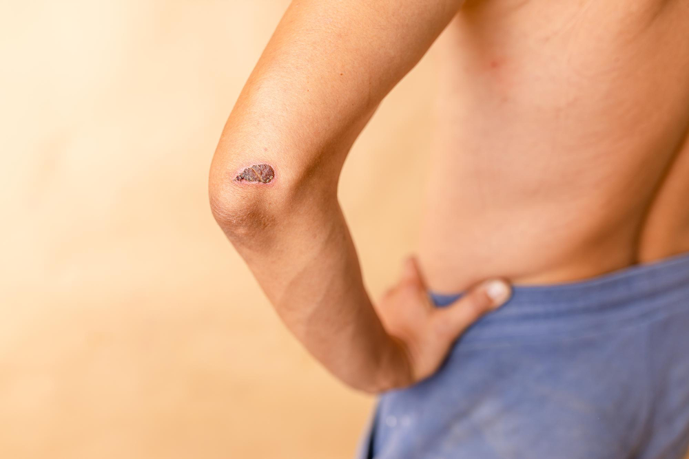 wound healing