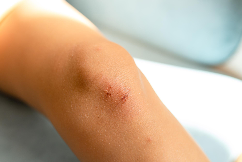 wound healing